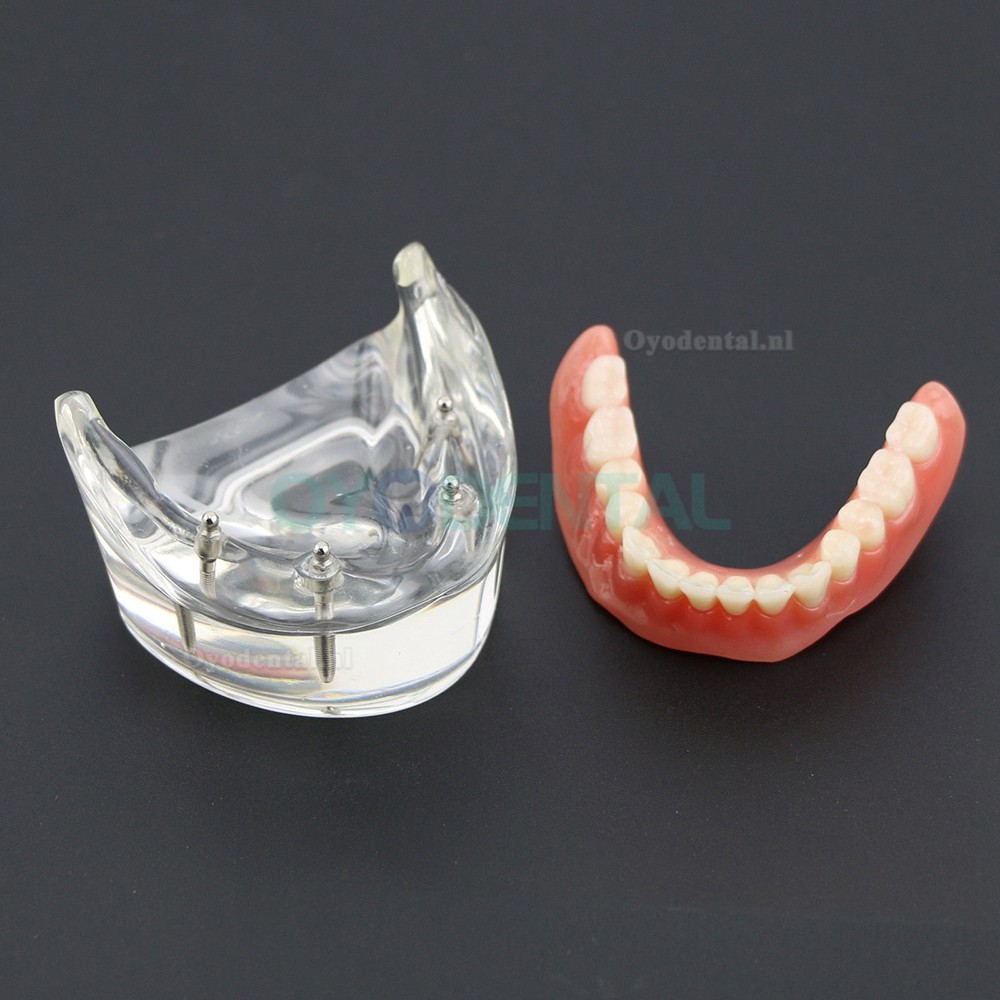 Demo-onderzoek tandheelkundige onderste tanden Model 6002 02 Overdenture Inferior 4 implantaten